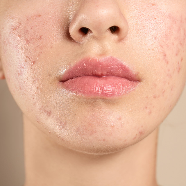 Close-up of face with visible acne.